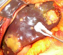 Метастазы рака поджелудочной железы в печень